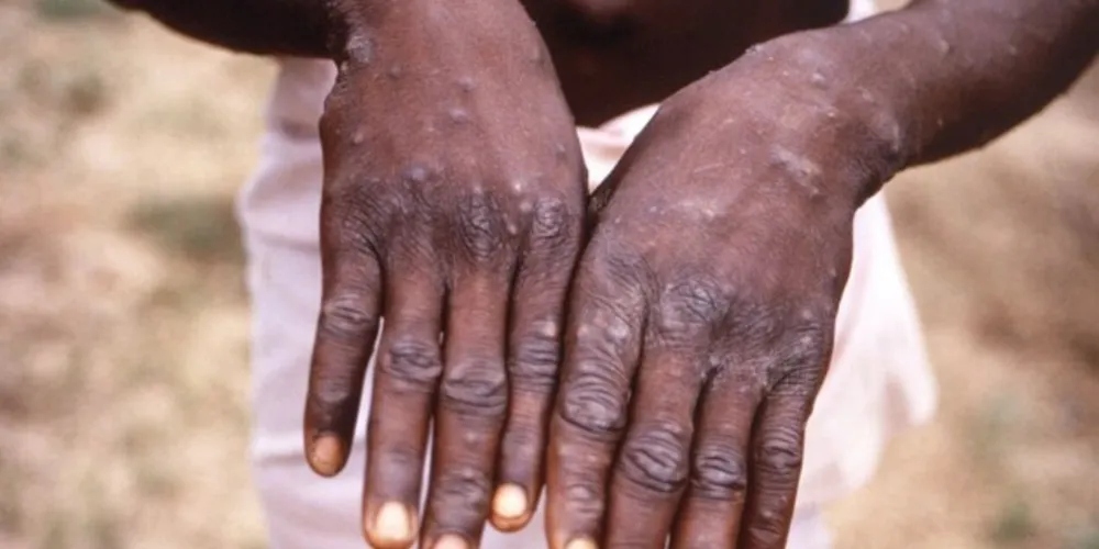 Espanha testa 23 casos suspeitos