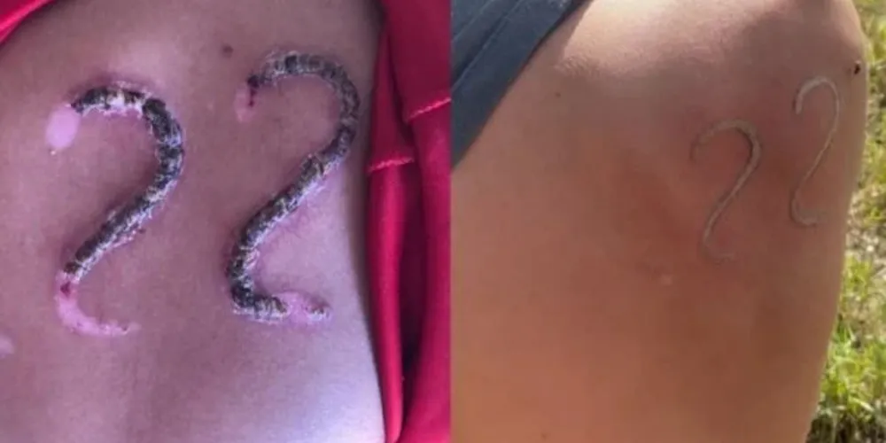 Adolescente de 17 anos teria feito a marca após se sentir desafiado pelos amigos