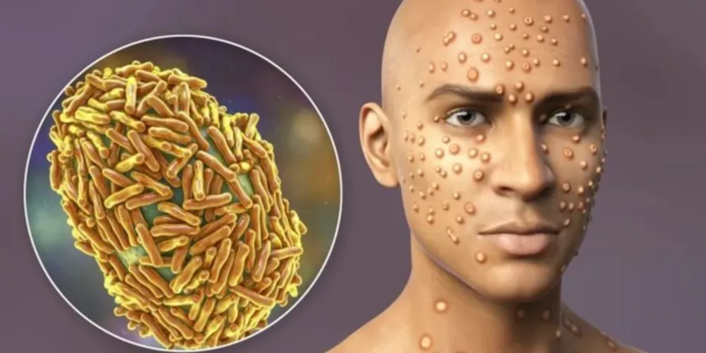 No Brasil, conforme a última atualização do Ministério da Saúde, de 21 de agosto, há 3.788 casos confirmados