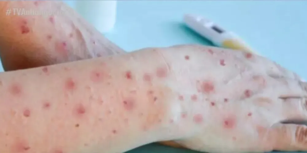 'Varíola dos macacos' PR ocupa 6º lugar na lista de casos por estado