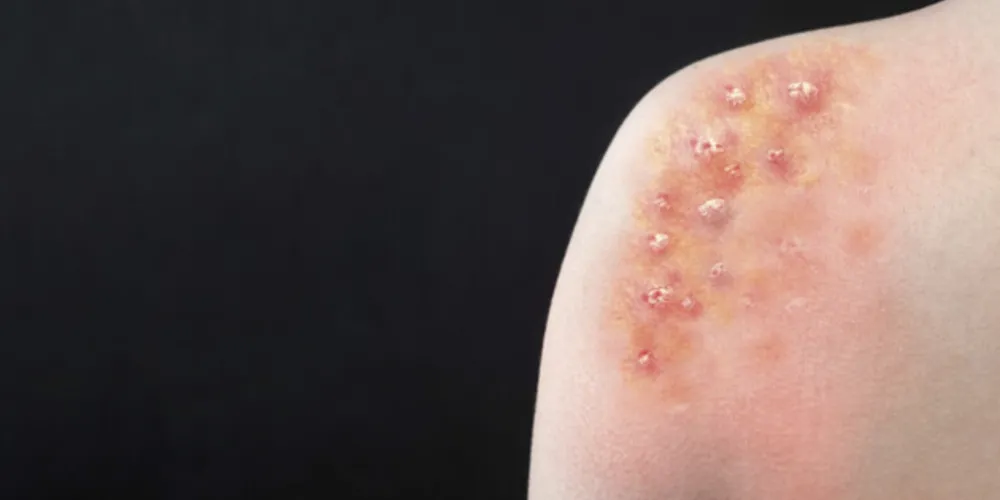 Com as confirmações, o Paraná chega a 153 casos de Monkeypox