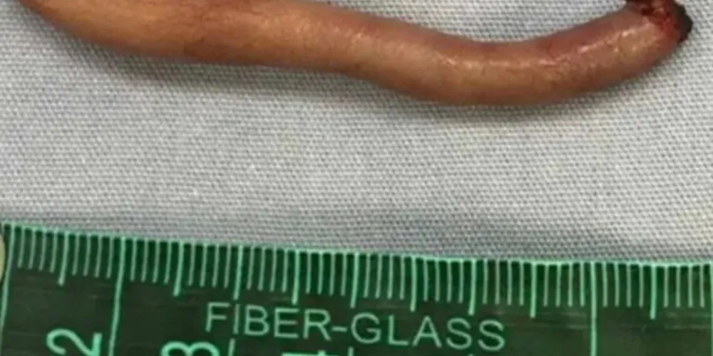 Situação rara foi registrada em uma bebê mexicana