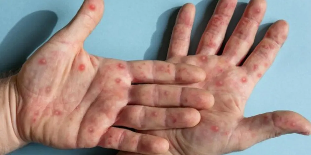 Palmeira, município da região, também confirmou seu primeiro caso nesta quarta-feira