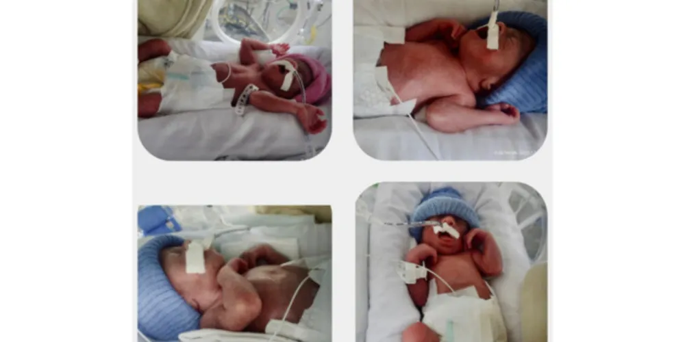 Referência no atendimento materno-infantil, HUOP realiza parto de quadrigêmeos, Maria Vitória, Gabriel, Rafael e Samuel