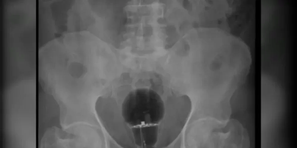 Exames de imagem mostraram que uma lâmpada foi enfiada em seu reto