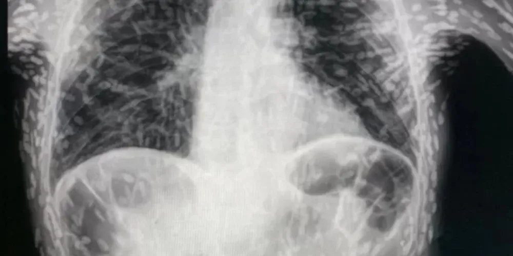 Ovos de tênia encontrados no tórax já estavam mortos e calcificados