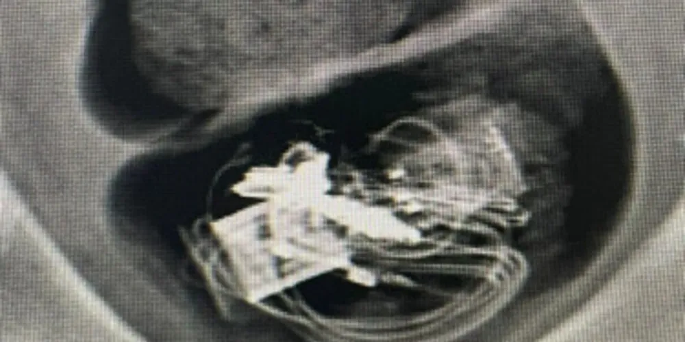 Em raio-X foi contato que no intestino do homem havia um fone de ouvido e pen drive