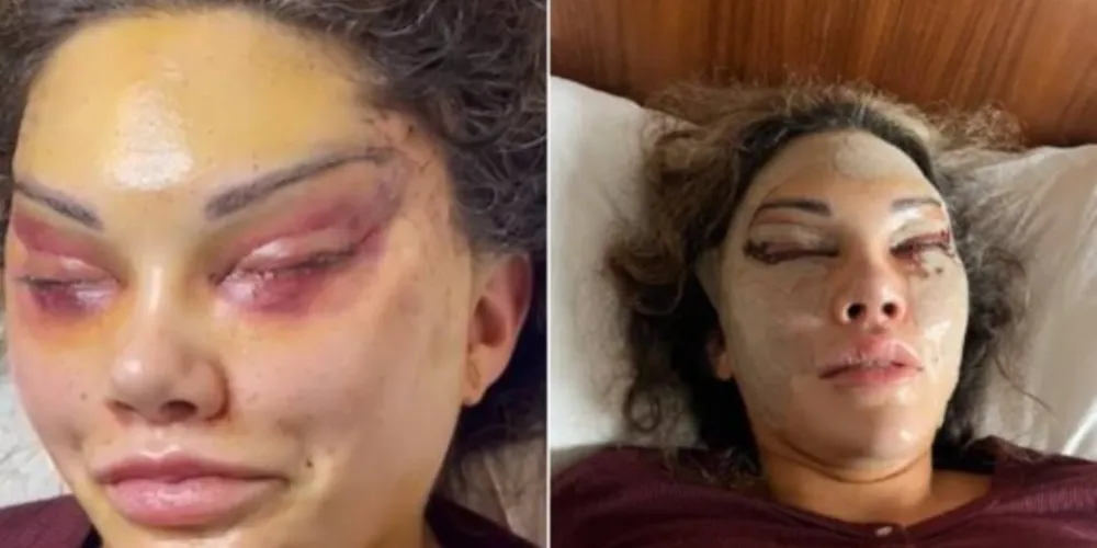 O doutor Hakan Ozocak, que realizou o procedimento, afirmou que a cirurgia é chamada de "olhos de gato"