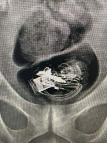 Em raio-X foi contato que no intestino do homem havia um fone de ouvido e pen drive