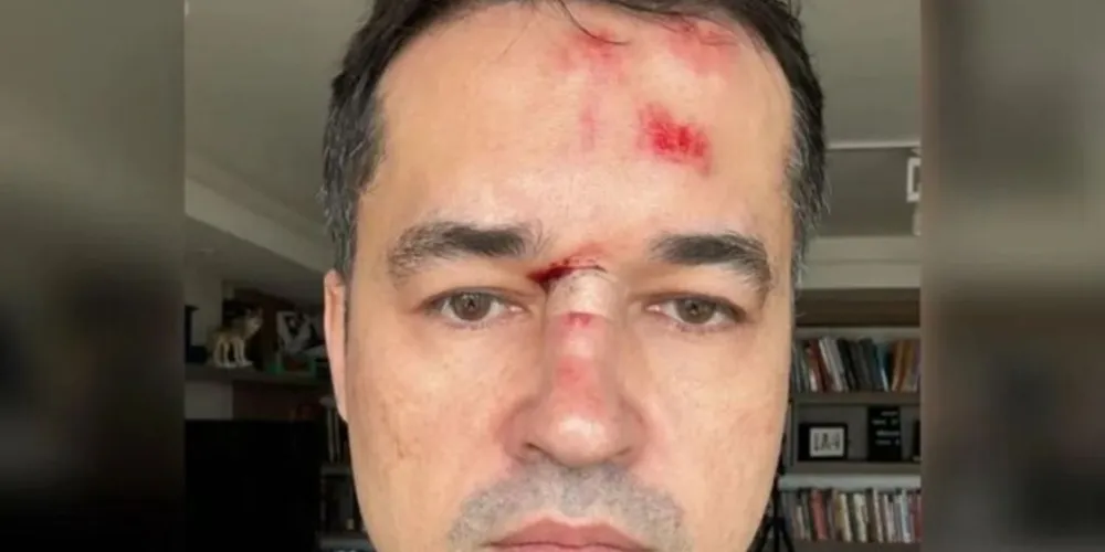 Na live, Deltan estava com curativo no nariz e um galo na testa