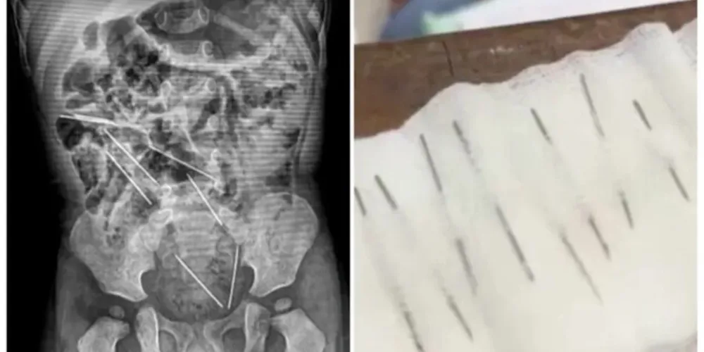 As agulhas estavam localizadas em diferentes partes do estômago