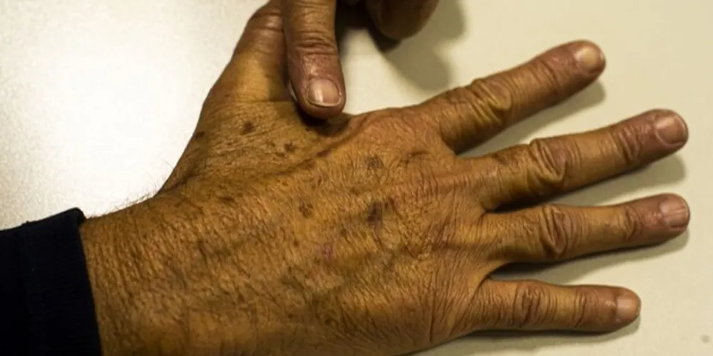 A inovação permite que pacientes não precisem mais passar por cirurgia