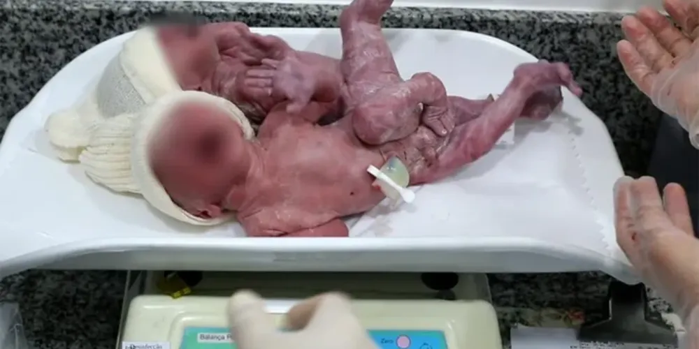 O nascimento ocorreu nesta quarta-feira (27) e, segundo a médica responsável pelo parto, os dois estão unidos pelo sacro, que é um osso na base da coluna