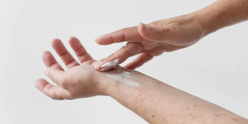 A dermatite atópica exige cuidados e pode ser controlada.