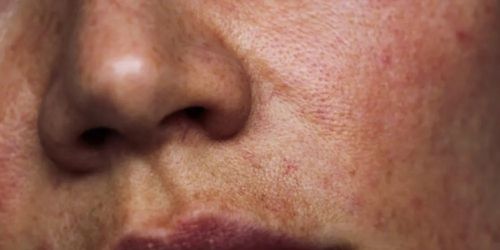 Doutora fala sobre os cuidados para evitar o melasma no rosto