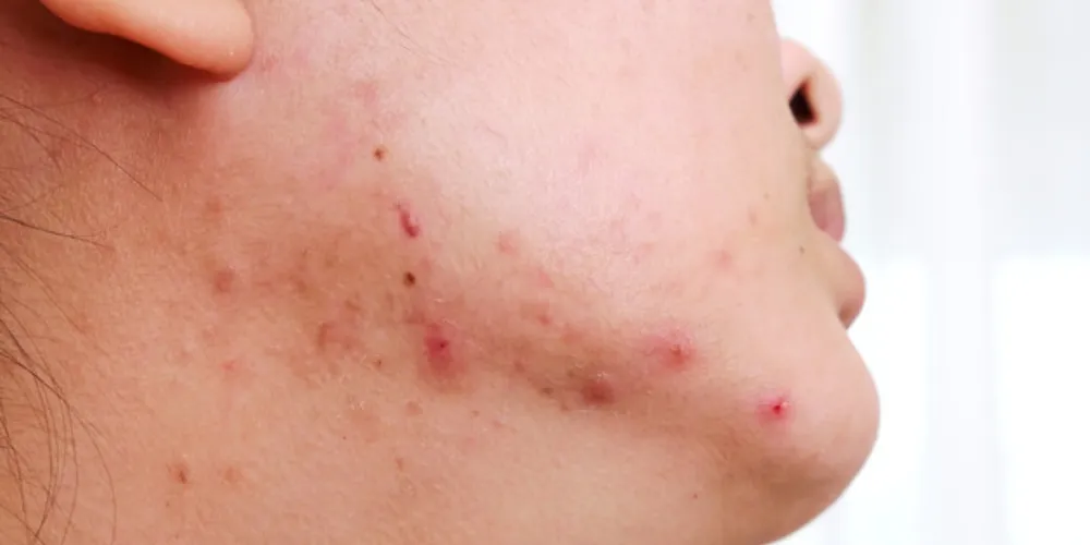 Garota jovem com problema de espinha na pele