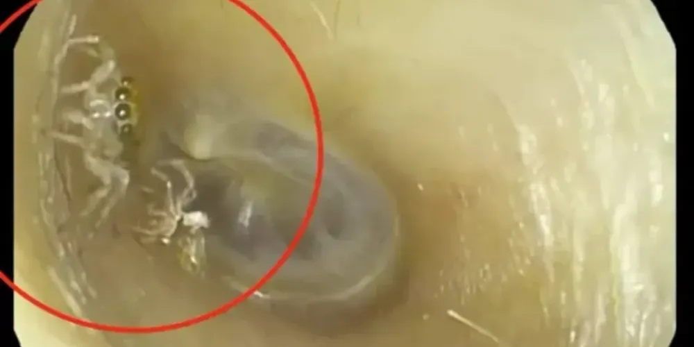 O aracnídeo realizou a troca do exoesqueleto no ouvido da mulher