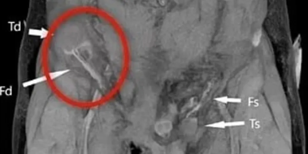 O jovem, que não teve identidade revelada, sofreu um desvio ectópico do testículo