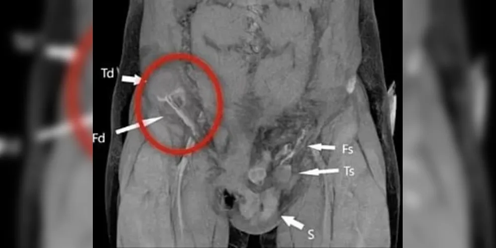 O jovem, que não teve identidade revelada, sofreu um desvio ectópico do testículo