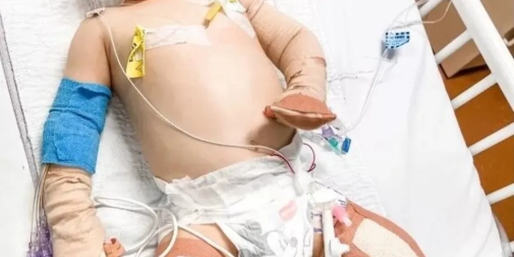 Pequeno Ryan Lines, da Austrália, teve de passar por procedimentos cirúrgicos