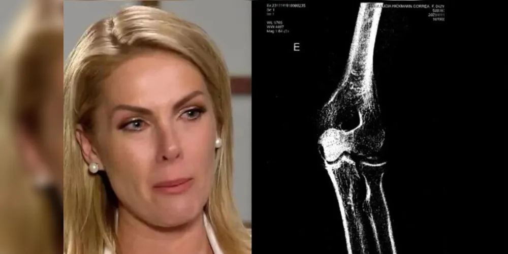 Ana Hickmann acusa o marido de agredi-la em casa, em Itu, no interior paulista