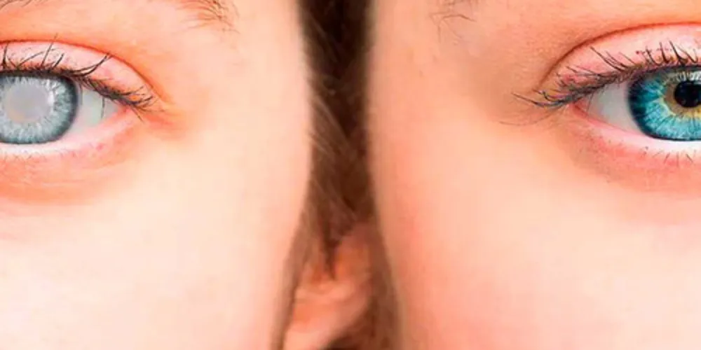 Na fase inicial, a catarata passa despercebida e muito pacientes ficam surpresos quando recebem o diagnóstico