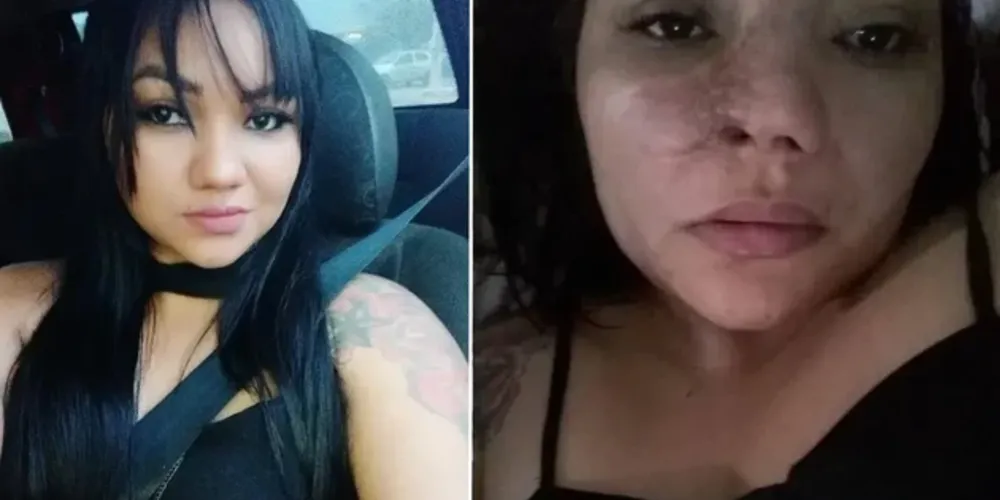 A alectomia é feita para reduzir as asas do nariz