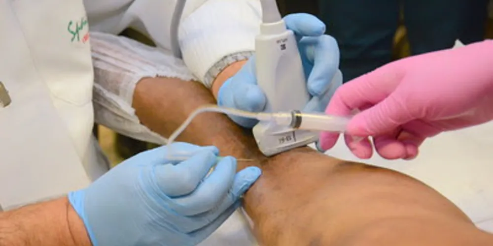 Como funciona o tratamento de escleroterapia com espuma? Entenda tudo sobre as indicações, contraindicações e principais recomendações