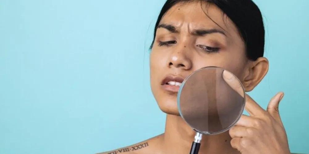 Pare de Esconder a sua Pele com Produtos que não vão Controlar o seu Melasma