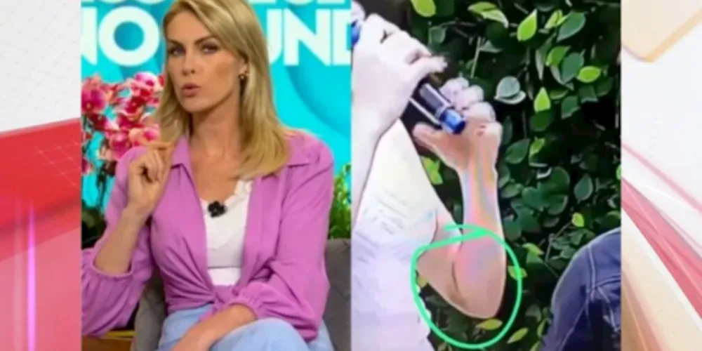 Durante um segmento do programa que ocorreu ao ar livre, o hematoma no braço de Ana era claramente visível