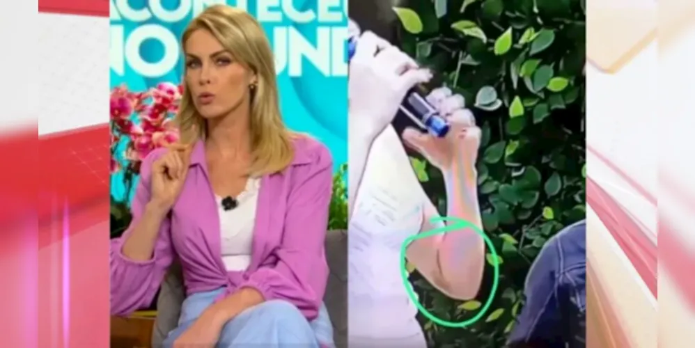 Durante um segmento do programa que ocorreu ao ar livre, o hematoma no braço de Ana era claramente visível