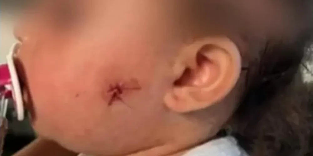 O projétil atingiu a bochecha da bebê