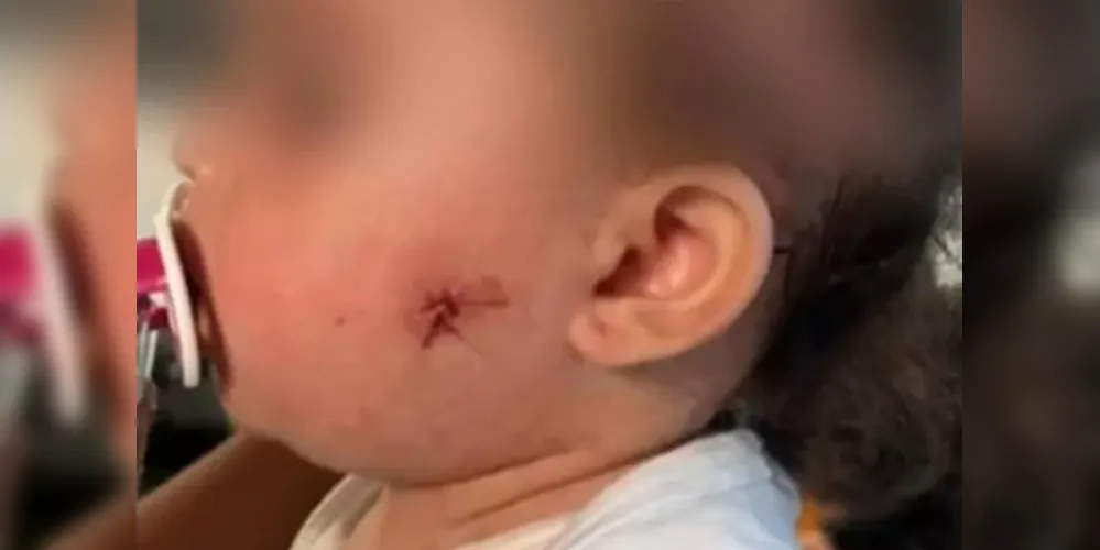 O projétil atingiu a bochecha da bebê