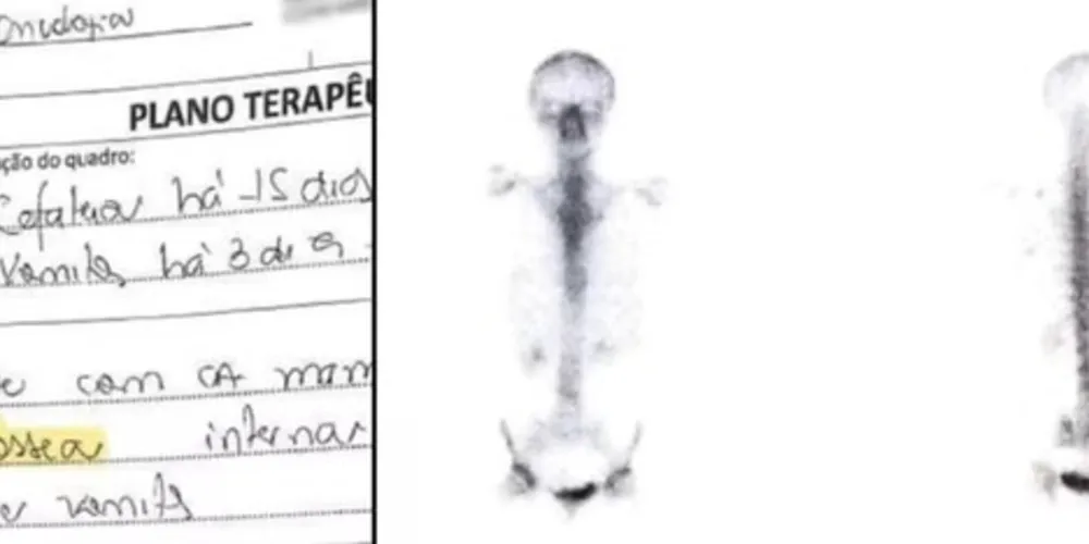 Ela teve um diagnóstico de metástase óssea errado após tratar um câncer de mama