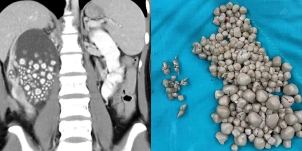 Apenas o rim esquerdo foi atingido