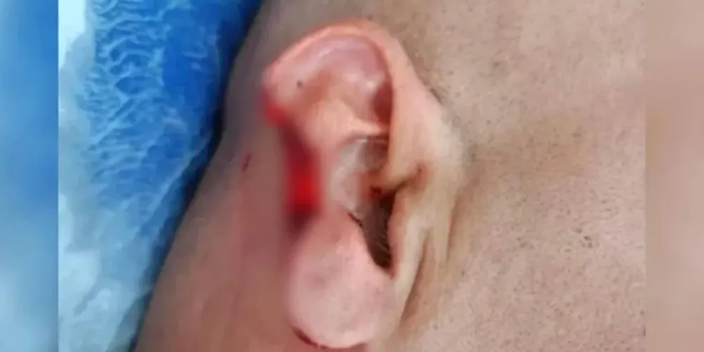 Parte da orelha do policial foi arrancada