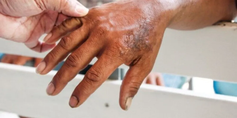 No Paraná, foram registrados, no último ano, 415 novos casos