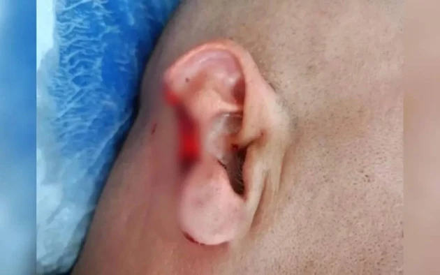 Parte da orelha do policial foi arrancada