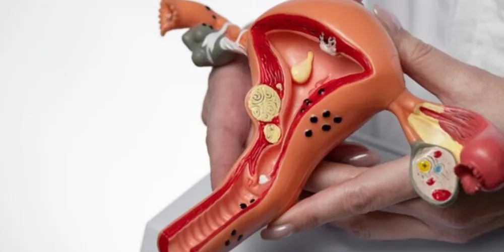 O percentual de pessoas que morrem pelo câncer de ovário é de 60% a 70%