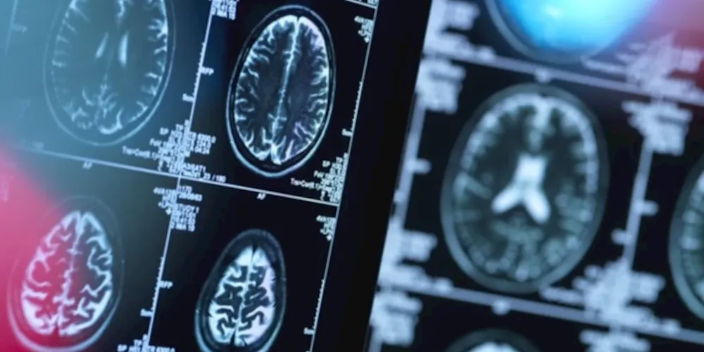 Velocidade do envelhecimento do cérebro aumenta a partir da meia idade