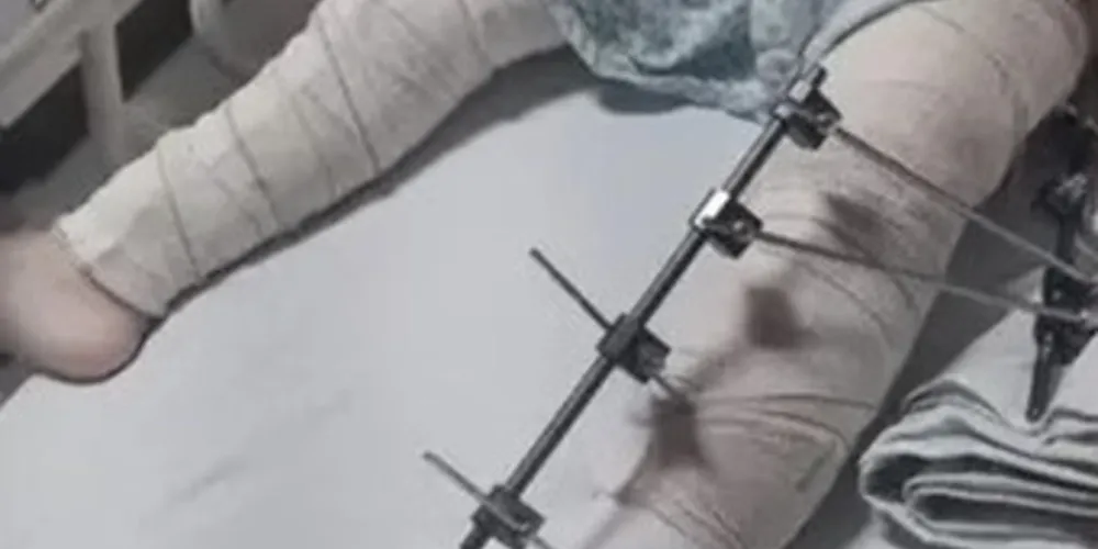 Criança foi submetida a um procedimento cirúrgico na perna errada