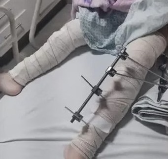 Criança foi submetida a um procedimento cirúrgico na perna errada