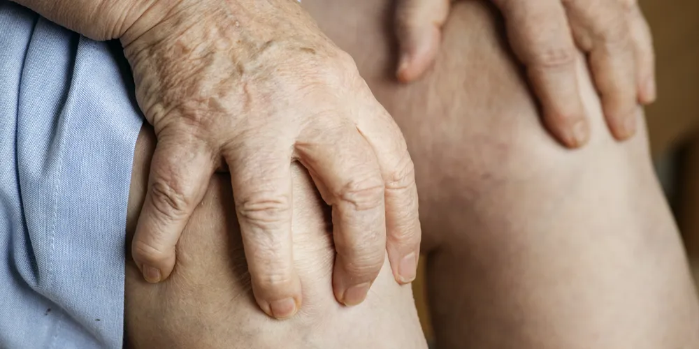 As varizes atingem 38% da população, sendo encontradas em 30% dos homens e 45% das mulheres