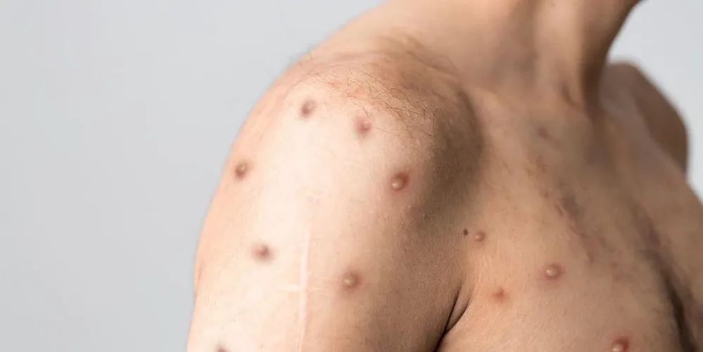 A maioria das infecções se concentra na faixa etária dos 30 aos 39 anos (751 casos)