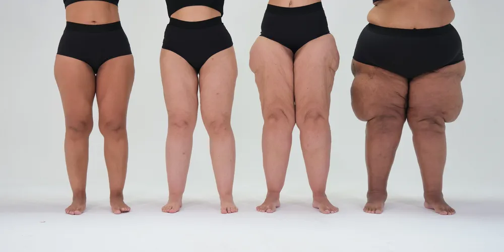 Mulheres com níveis diferentes de lipedema.
