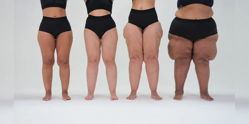 Mulheres com níveis diferentes de lipedema.