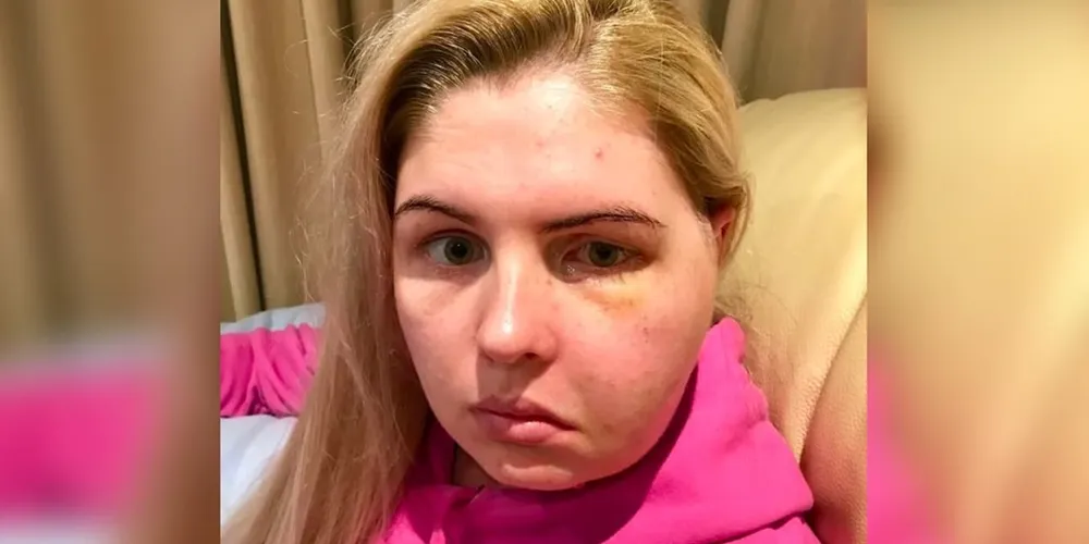 Tina também passou um período sem conseguir falar ou se alimentar