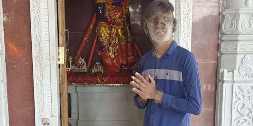 O jovem Lalit Patidar, possuí uma condição chamada hipertricose