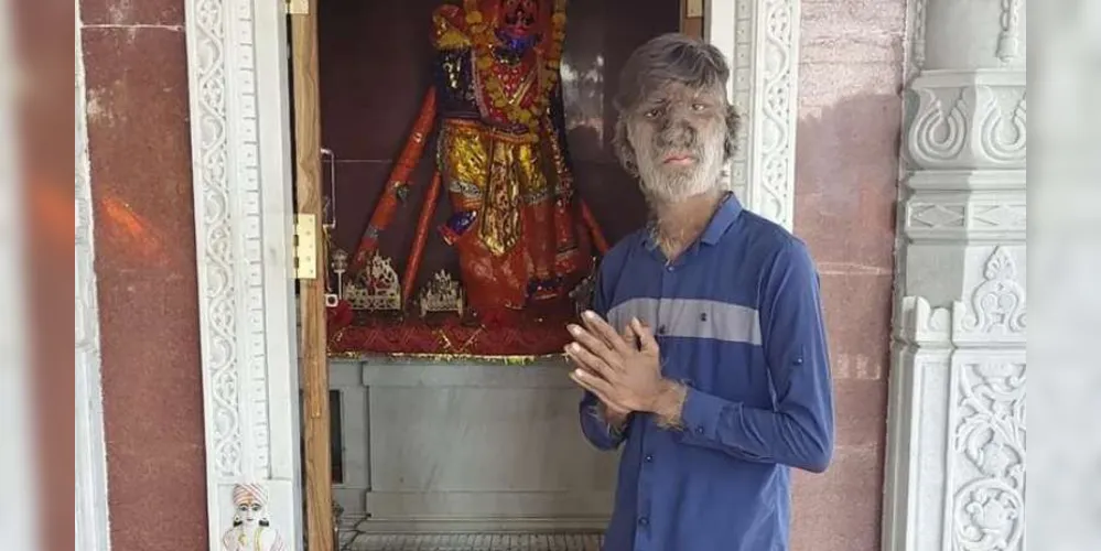 O jovem Lalit Patidar, possuí uma condição chamada hipertricose