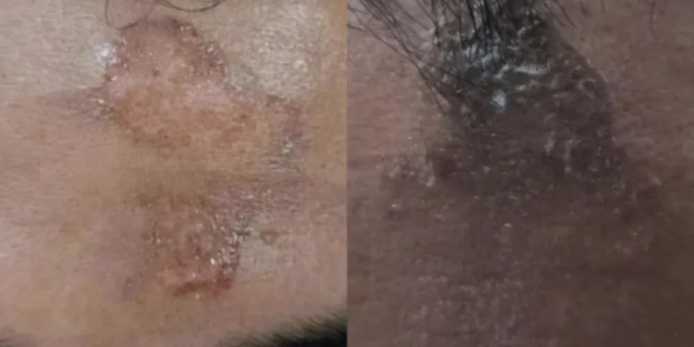 Queimaduras na testa de fiéis